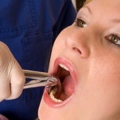 10 советов после удаления зуба